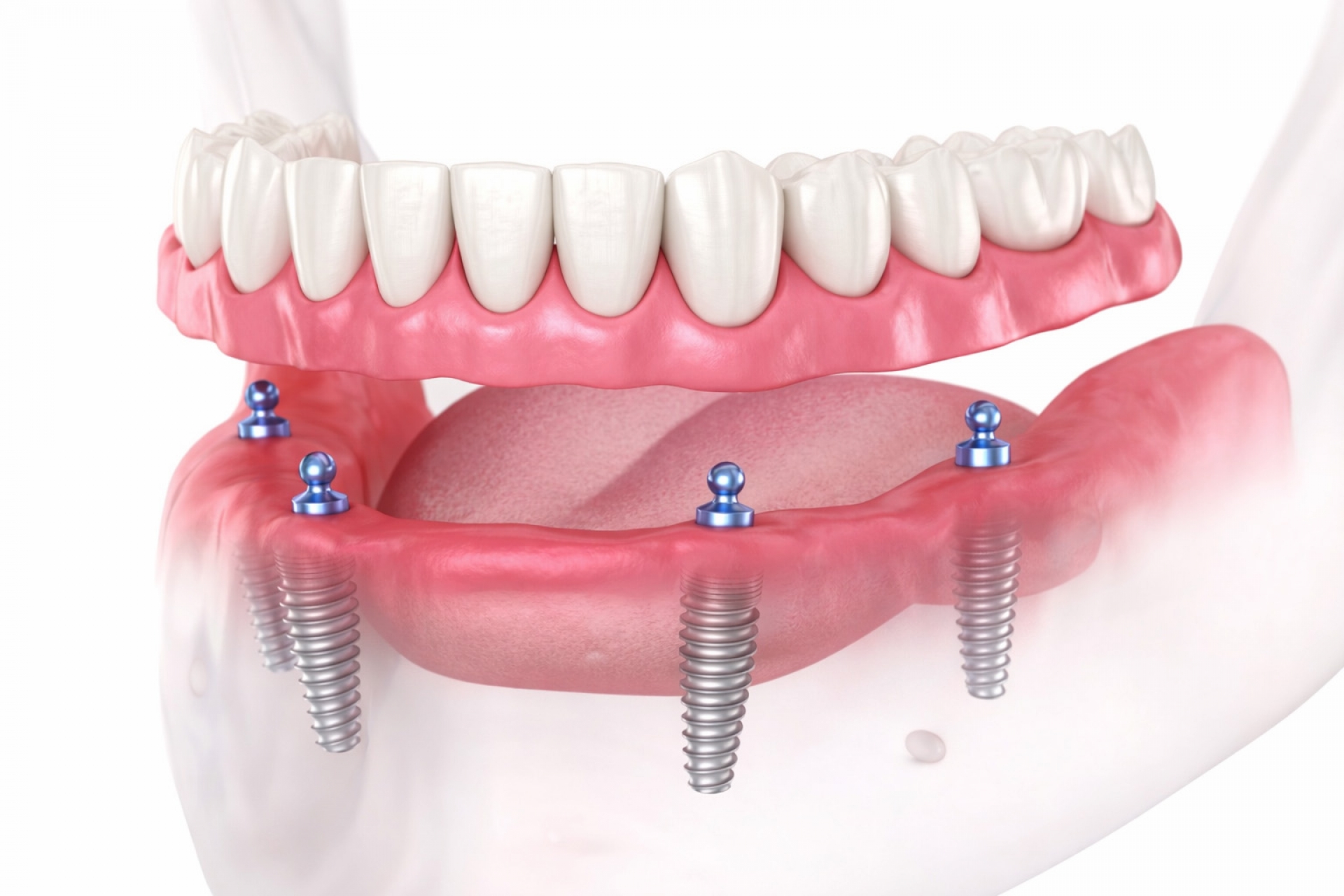 FULL AĞIZ İMPLANT TEDAVİSİ