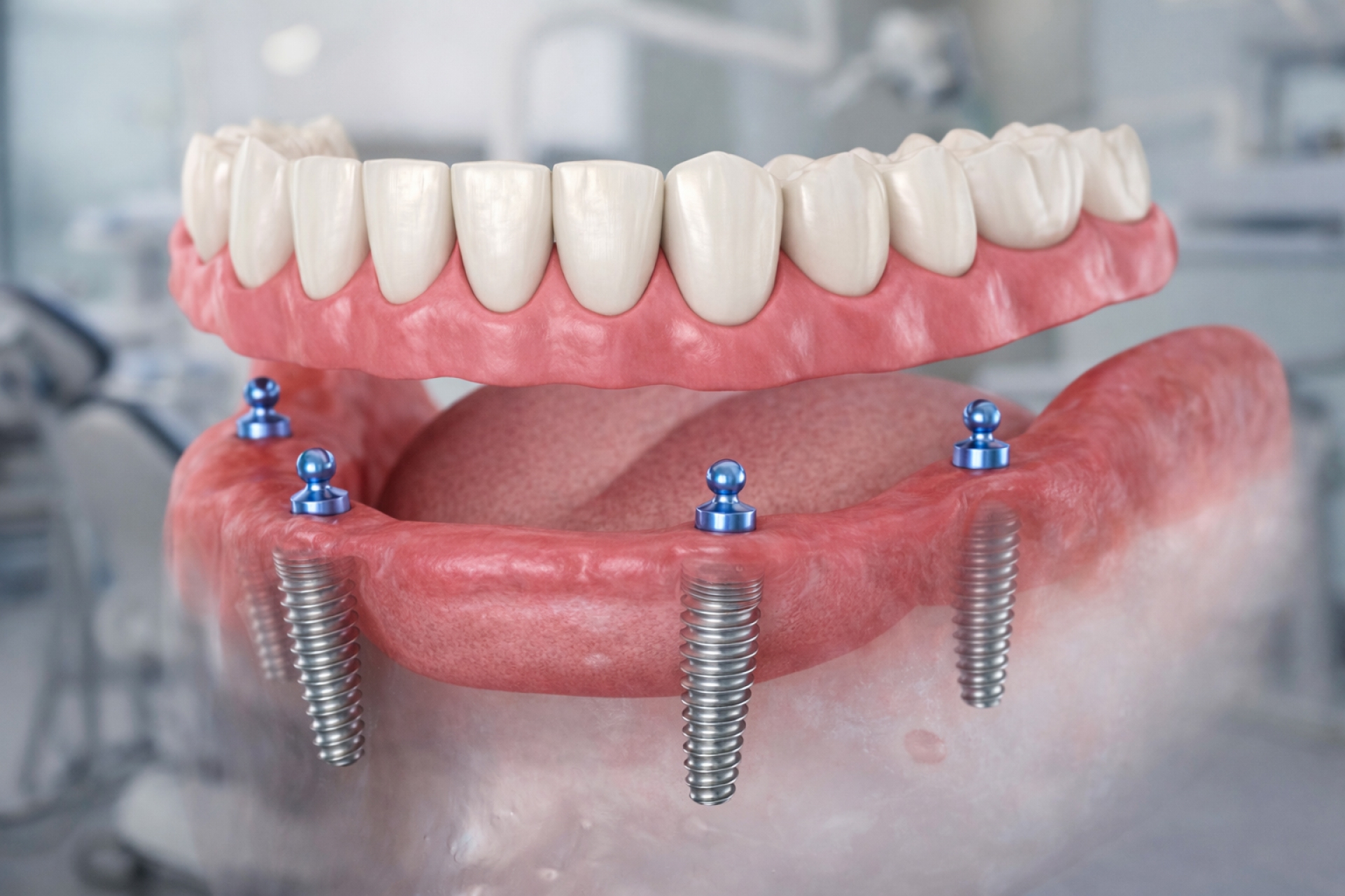 ПОЛНАЯ ИМПЛАНТАЦИЯ ЗУБОВ